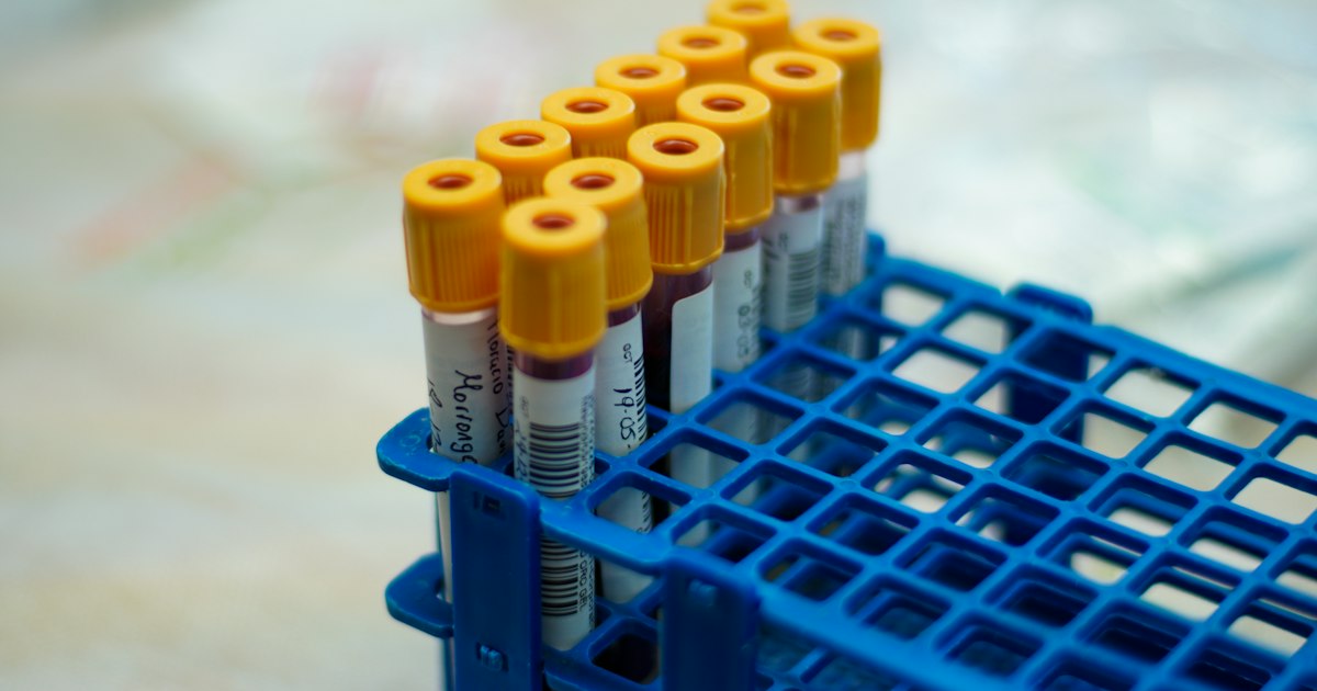 How to Prepare for the Homocysteine Test: Rules for Getting Tested